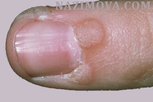 usl-laser-borodavka-nogot.jpg