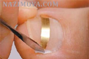 usl-laser-vrosshiy-nogot-pl.jpg